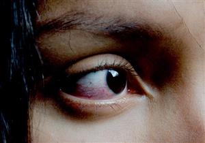 عرض لأكثر من مرض- إليك أسباب احمرار العين اليمنى