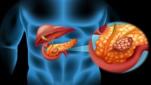 أمل جديد في علاج سرطان البنكرياس.. تعرف عليه