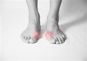 أعراض ارتفاع ضغط الدم- 5 علامات تظهر على القدمين