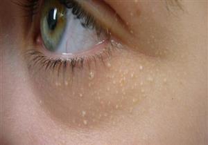 علاج الزوائد الجلدية حول العين- السبب خطير