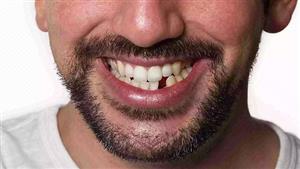 دواء جديد يعيد نمو الأسنان التالفة من جديد