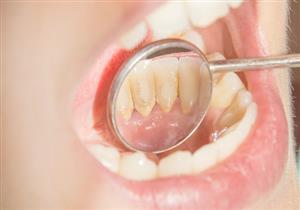 في 8 خطوات- دليلك لمنع تكوين جير الأسنان