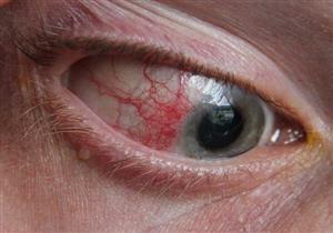 احذر- التهاب المفاصل الروماتويدي يهدد عينيك بهذه المشكلات