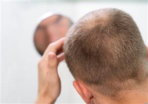هل يمكن أن يتساقط الشعر بعد الزراعة؟- طبيب يجيب "فيديو"