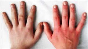 هل تعاني من تورم الأصابع في الشتاء؟.. إليك الأسباب والعلاج