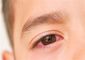 احمرار العين عند الأطفال- 5 طرق طبيعية لعلاجه