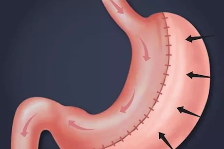 ما هو النظام الغذائي بعد عملية تكميم المعدة؟