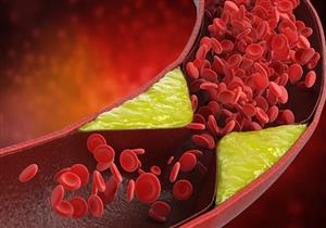 قلبك في خطر- 6 عادات يومية ترفع الدهون الثلاثية بالدم