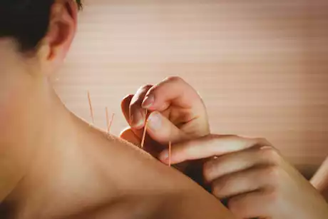 الوخز بالإبر يعالج أمراض متعددة- حقيقة أم خرافة؟