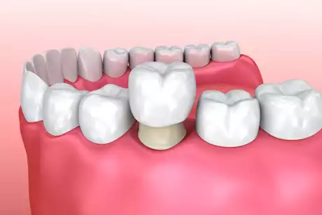 هل يمكن تركيب الطربوش على أي ضرس؟ استشاري يجيب