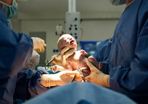 طبيب يؤكد: الولادة القيصرية ضرورية في هذه الحالات "فيديو"