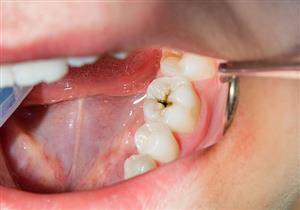 س & ج- دليل شامل عن تسوس الأسنان بعد الحشو