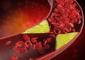 علامات بالجلد تكشف ارتفاع الكوليسترول بالدم- احذرها