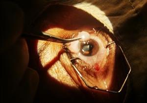 قد تصل للعمى- 6 مضاعفات لجراحة المياه البيضاء
