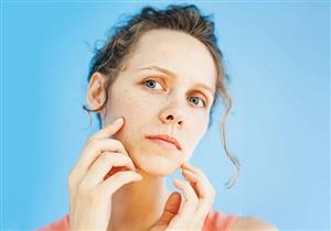 احذر- علامة تظهر على الوجه تدل على نقص فيتامين B12