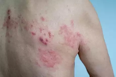 الحزام الناري،الأسباب والأعراض وطرق العلاج