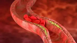 دراسة تكشف العلاقة بين تقلبات الكوليسترول وزيادة خطر الخرف