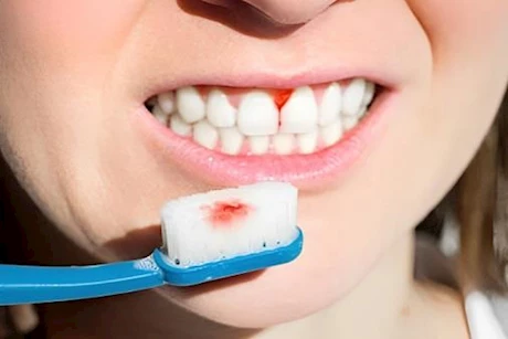 5 أطعمة يجب عليك تناولها لمنع نزيف اللثة 