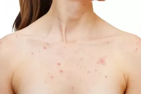 5 نصائح للتخلص من حبوب الصدر عند النساء- طبيبة توضح