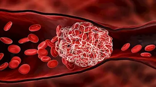 "قصر العيني" تقرر استخدام الجيل الجديد من أدوية إذابة الجلطات المخية