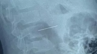 استخراج مسمار دباسة من بطن طفل في عملية دقيقة ببنها