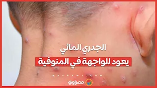 الجدري المائي يعود للواجهة  في المنوفية