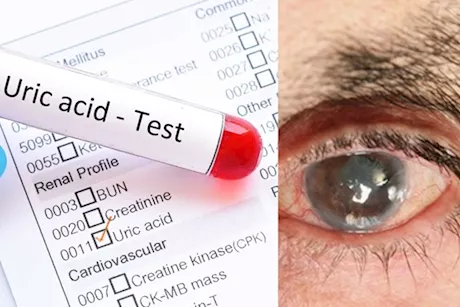 ماذا يحدث لعينيك عند ارتفاع حمض اليوريك بالدم؟