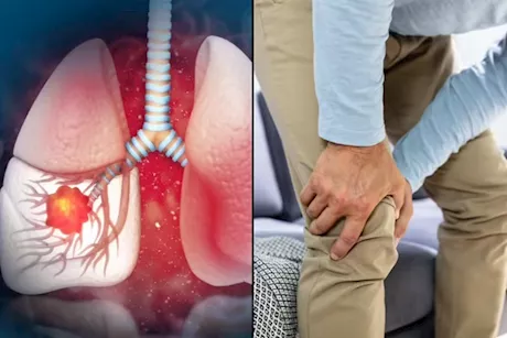 انتبه لساقيك- 6 أعراض مبكرة لسرطان الرئة تظهر عليهما