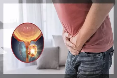 هل سرطان البروستاتا يؤثر على الإنجاب؟ طبيب يوضح