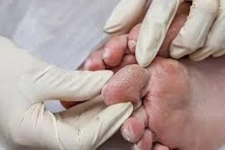 في اليوم العالمي للسكري.. 5 مضاعفات تظهر على القدمين