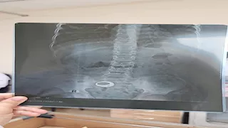 على طريقة "حياة أو موت".. مناشدات للبحث عن طفل غادر مستشفى بالبحيرة بخاتم ببطنه