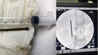 في 20 دقيقة.. فريق طبي يستخرج مسمارًا حادًا من أمعاء طفلة بالمنوفية