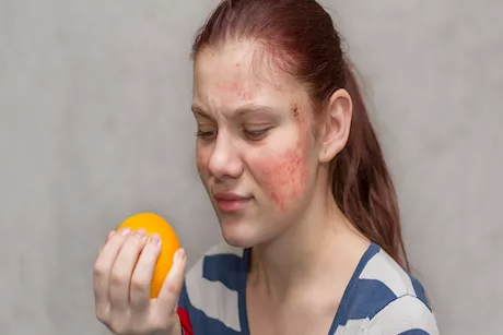 هذه الأطعمة تزيد أعراض حساسية الصدر.. طبيب يوضح