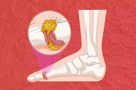 تظهر قبل النقرس- 5 أعراض مبكرة لارتفاع حمض اليوريك