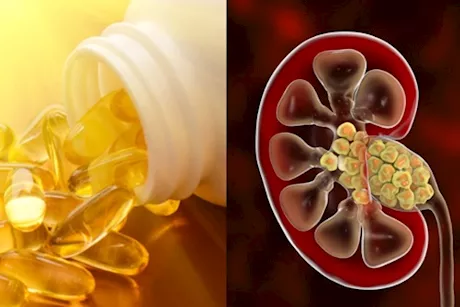 فرط فيتامين د يدمر الكلى- 6 أعراض تنذرك بتقليل جرعته