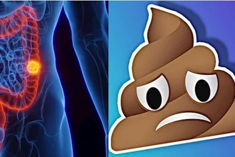 انتبه لبرازك- 4 أعراض مبكرة لسرطان القولون تظهر فيه
