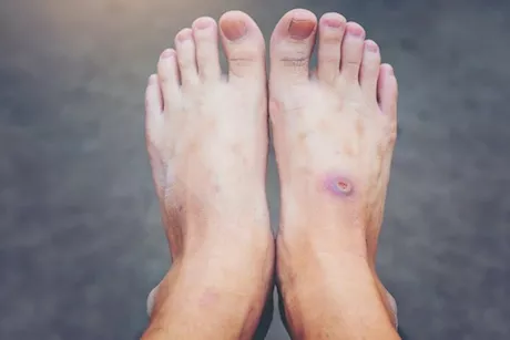 كيف يلتئم جرح السكر؟- طبيب يجيب