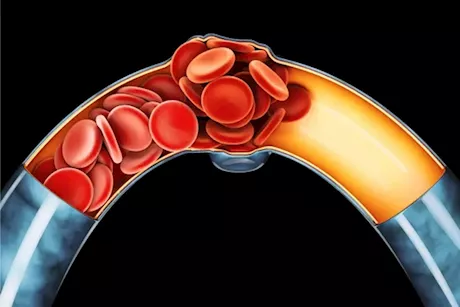 الأعراض الخفية لانسداد الشرايين- 5 علامات صامتة احذرها