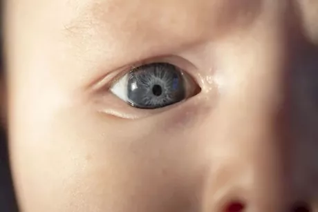 تسبب المياه البيضاء.. طبيب يحذر من قطرة العين دون استشارة طبية للأطفال