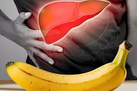 ماذا يحدث لمريض الكبد عند تناول الموز؟
