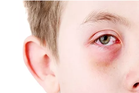 استشاري يوجه رسالة لأولياء الأمور: هذه المشكلة قد تضر بعيون طفلك