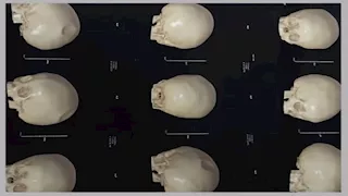 فريق طبي بالإسكندرية ينقذ حياة طفل بعد سقوطه وتهشم جمجمته