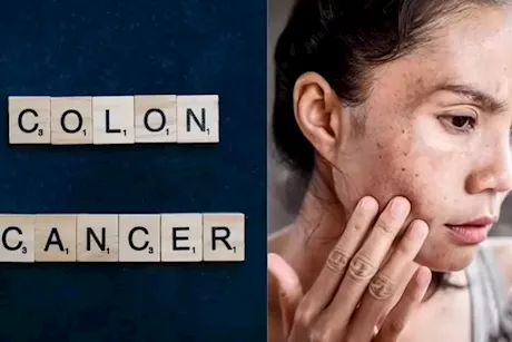 انتبه لبشرتك- 4 أعراض لسرطان القولون قد تظهر عليها