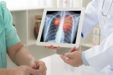 5 علامات تشير إلى سرطان الرئة.. من بينها ضيق التنفس