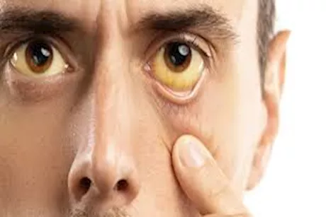 تظهر على الوجه والعينين.. علامات للكبد الدهني تجنبها