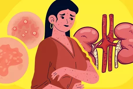 انتبه لهذه العلامات- كيف يبدو جلدك عندما تفشل الكليتان؟