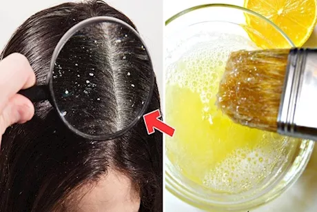 طبيب: هذه الوصفة تخلصك من قشرة الشعر نهائيًا