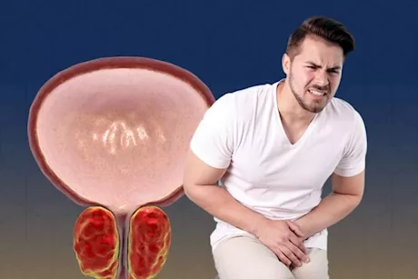 هل احتقان البروستاتا يمكن أن تتسبب في الالتهابات؟.. طبيب