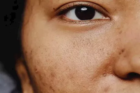 أيهما أفضل لإزالة التصبغات.. الأجهزة الطبية أم الكريمات الموضعية؟