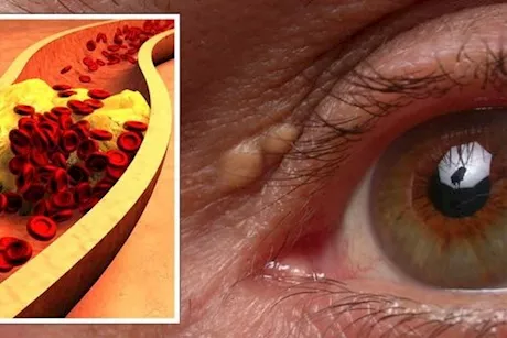 ماذا يحدث لعينيك عند ارتفاع الكوليسترول بالدم؟